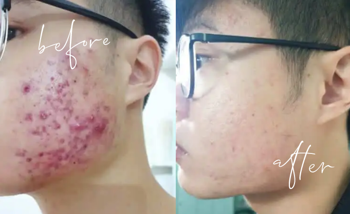 Indulgence Beauty facial treatment results